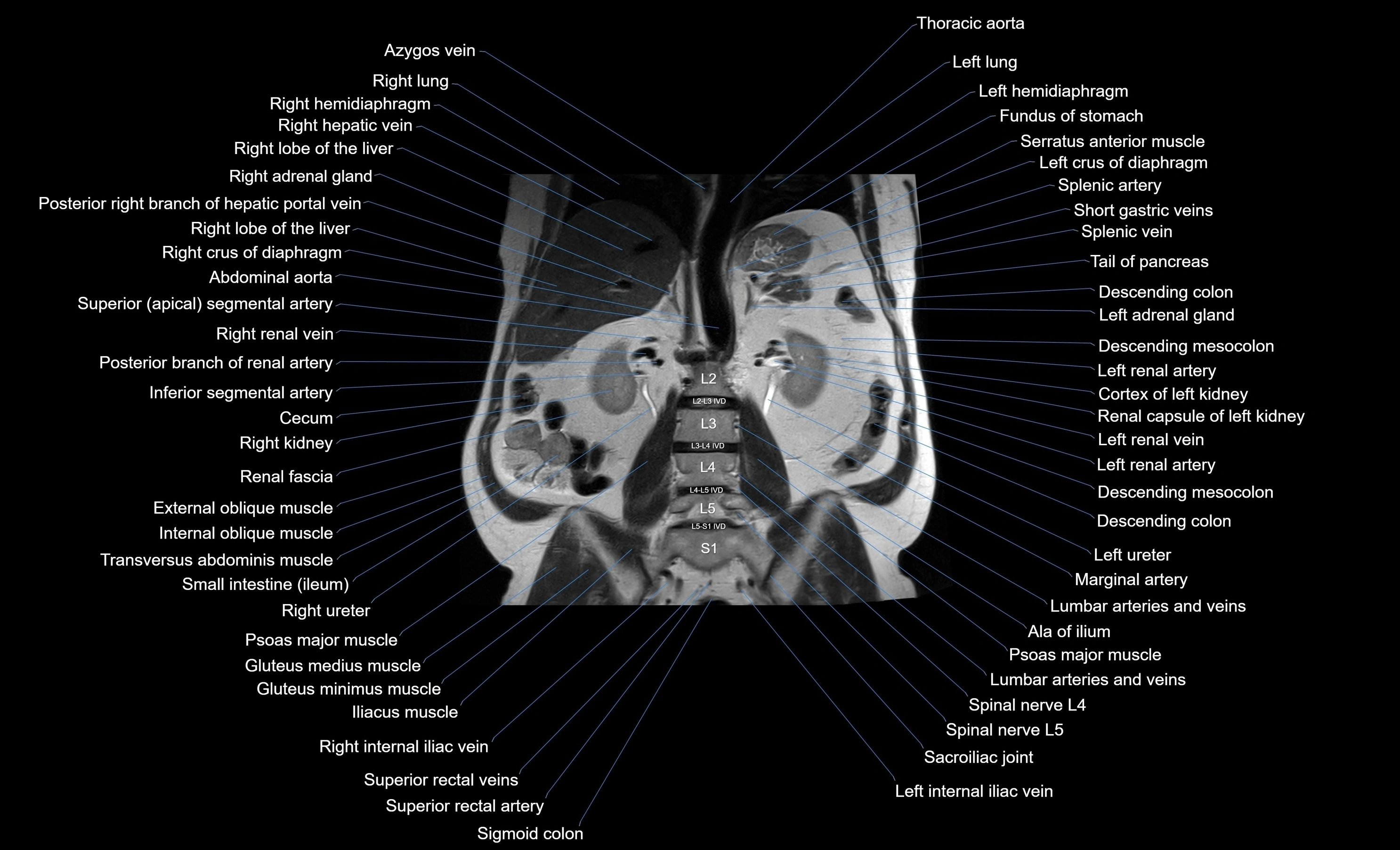 MRI Abdomen coronal labelled cross sectional anatomy radiology  image-img-00001-00036.webp